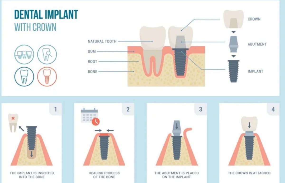 Fort Worth Dental Practice Offers Affordable Implant Solutions with Transparent Pricing