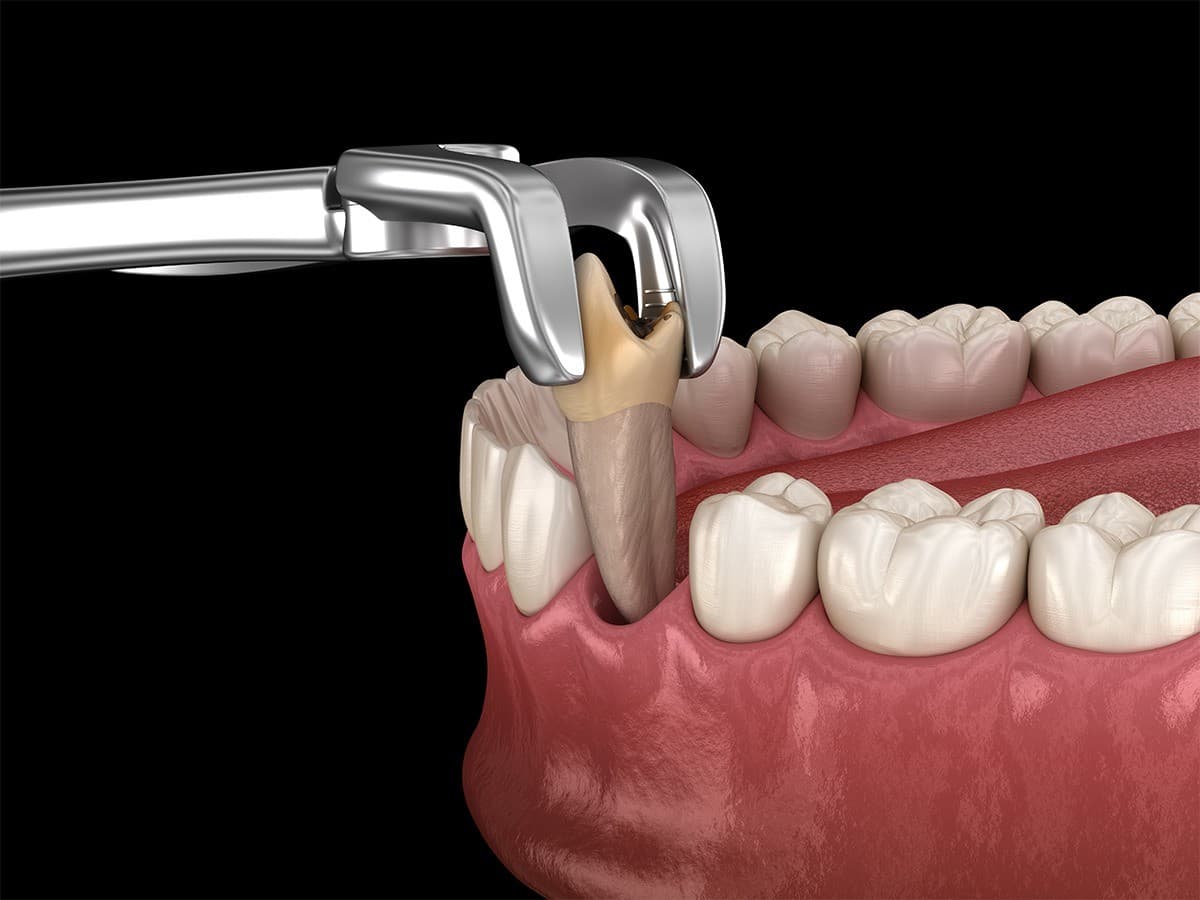 Sioux Falls Oral Surgery Practice Publishes Guide to Ease Patient Anxiety About Tooth Extractions