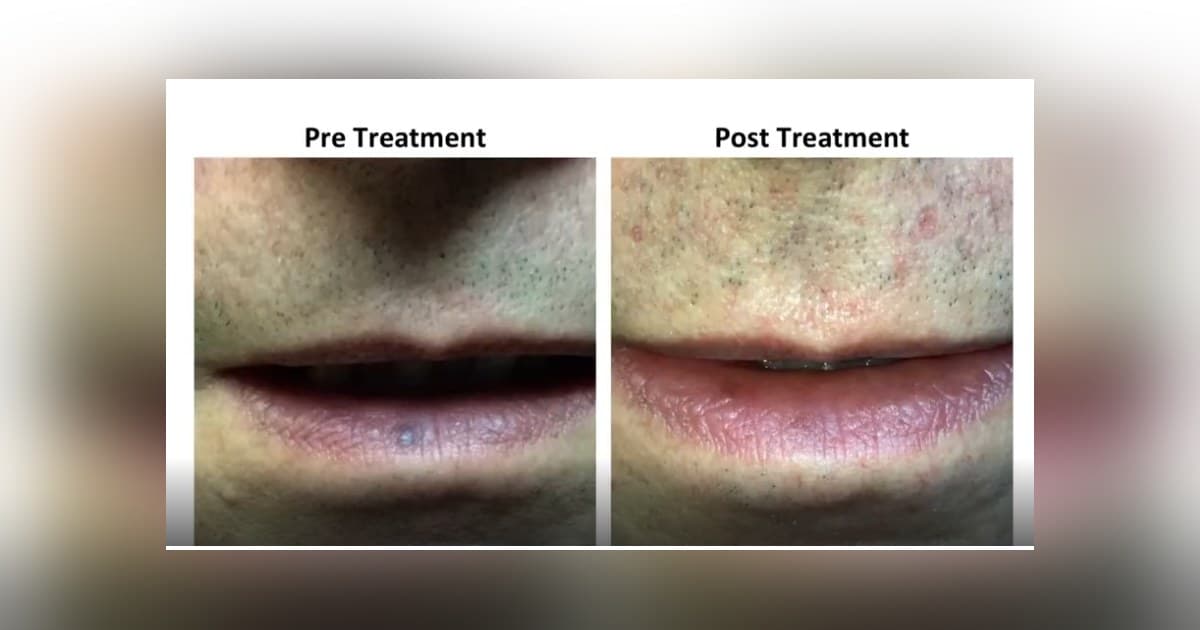 Clifton Vascular Surgeon Offers Laser Treatment for Venous Lake, a Common but Underrecognized Lip Lesion