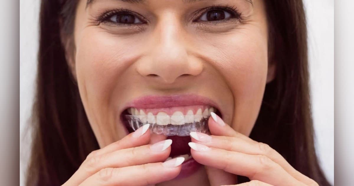 Sherman & Balhoff Orthodontics Offers Clear Aligners for Overbite and Crossbite Treatment in Baton Rouge