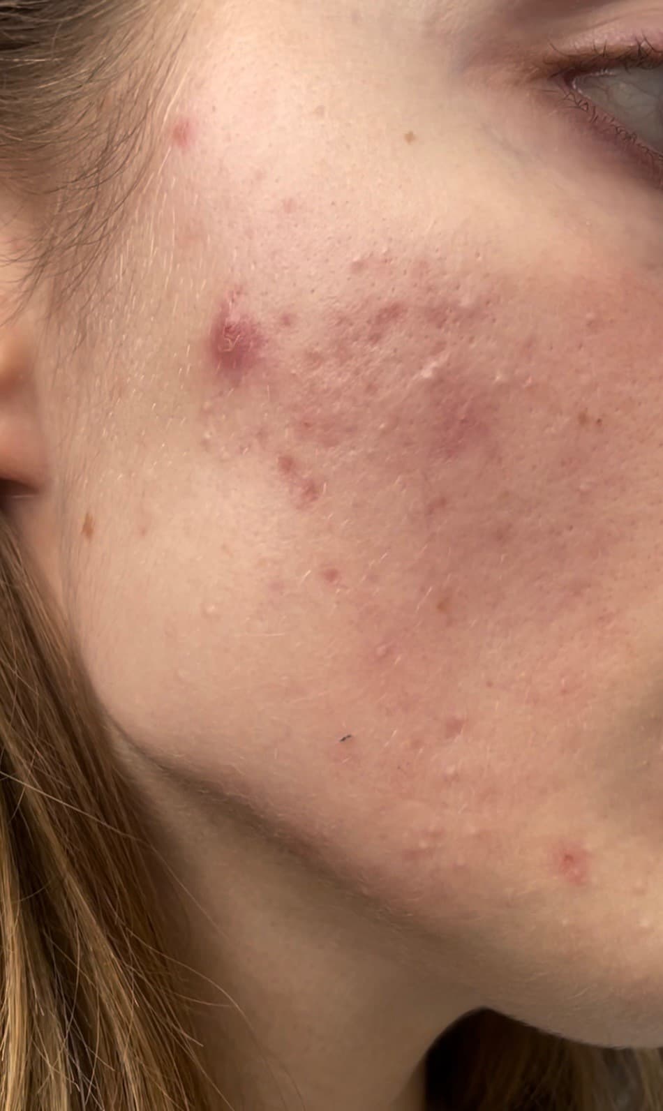 XVesuvius Wins Men's Health Grooming Award for Best Acne Product