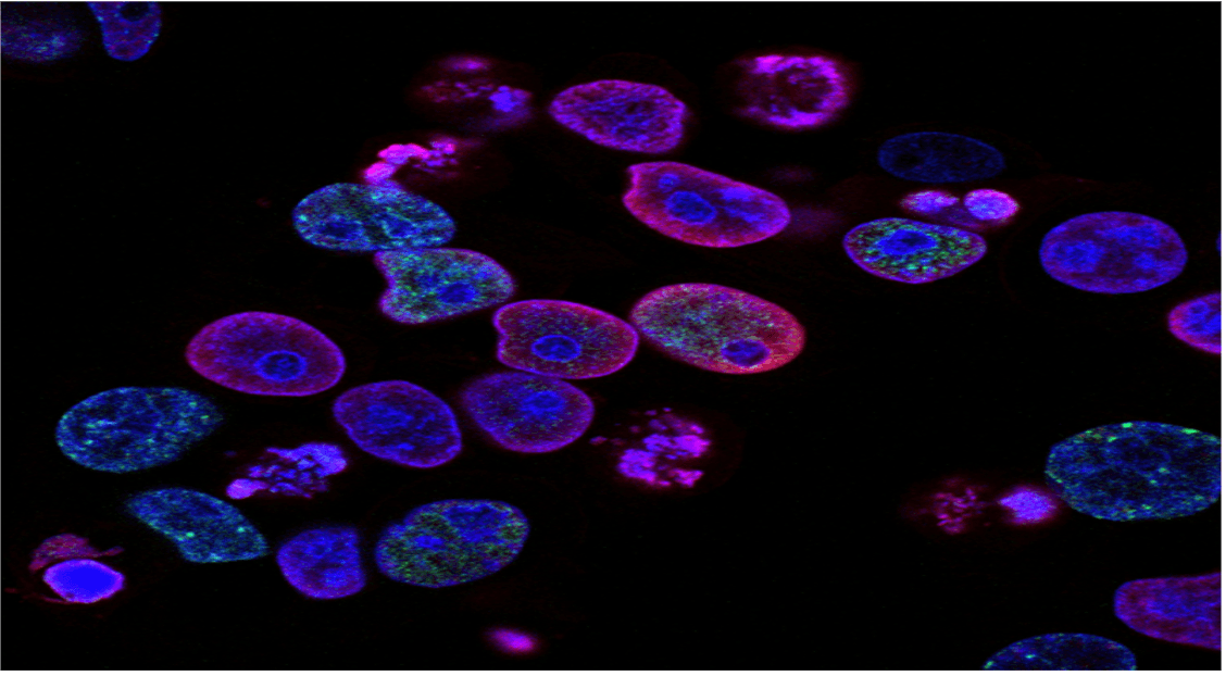 Potential Breakthrough in Metastatic Prostate Cancer Treatment Emerges